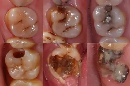 蛀了牙牙痛怎么快速止痛