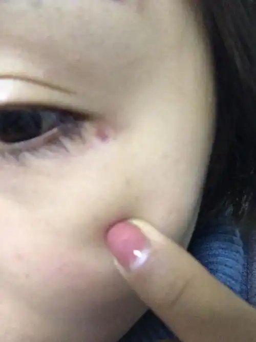 眼尾突然起了个红点不疼不痒 什么情况都没有,就