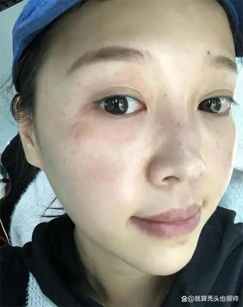 25岁女生长期熬夜长出老年斑,熬夜让你提前老去!