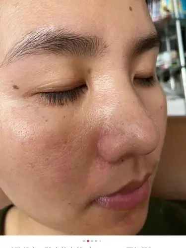 毛孔粗大最有效对策75毛孔粗大会显得我们的脸很粗糙,_圈子-新氧