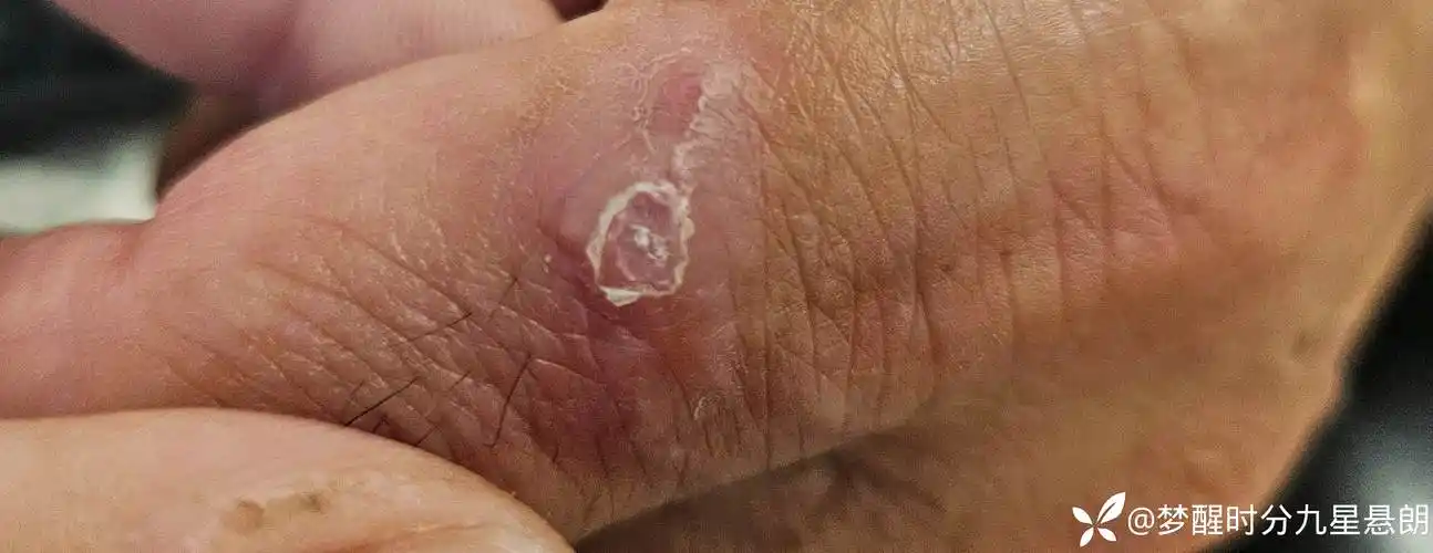 【异物排斥】手外伤术后线结反应.