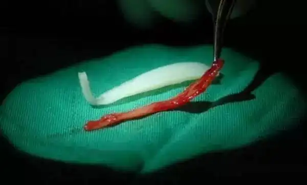 分裂剥离开,然后把硅胶放入中间,这样即使华丽的高鼻子假体也不会透光