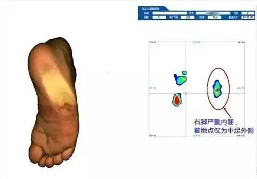 孩子内八字怎么办?儿童内八字的原因,类型及临床矫正策略