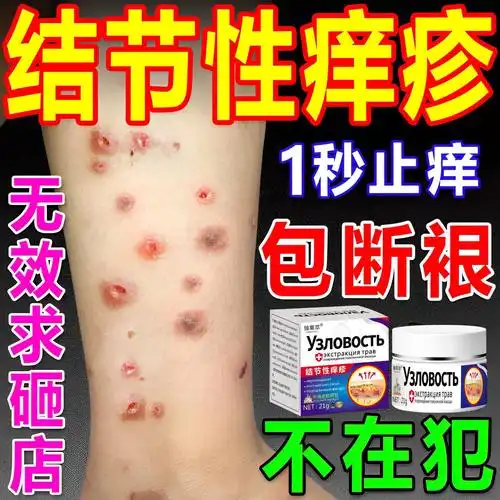 结节性痒疹特效治顽固硬疙瘩红斑痤疮全身瘙痒皮炎皮肤病止痒药膏