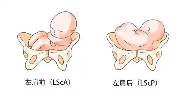 对胎位的描述loa  roa  lsa是?