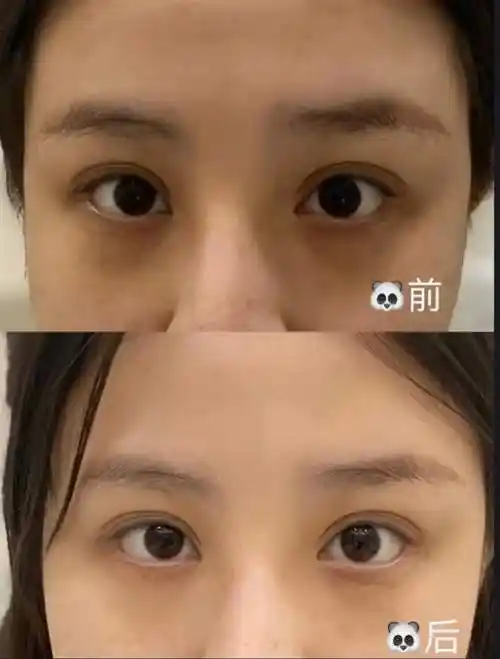 关于嗨体还傻傻分不清楚想祛颈纹填泪沟紧致到底怎么选过来人经验分享