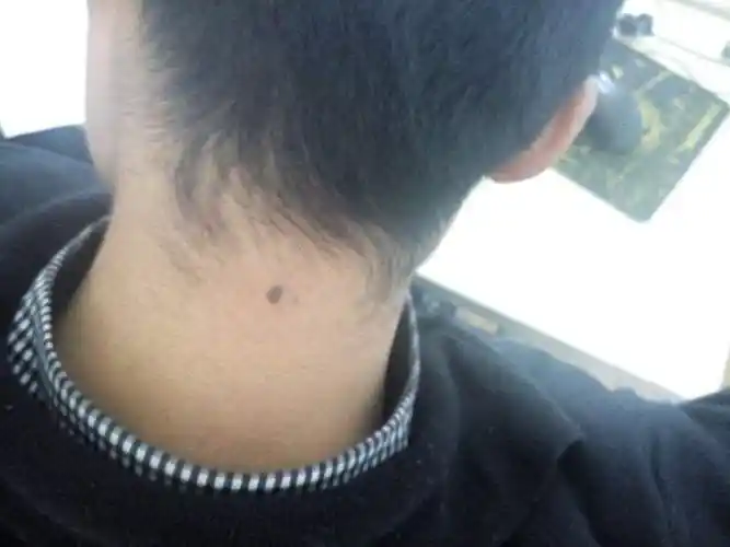 脖子上有痣的男人代表什么 脖颈上右侧有长痣代表什么