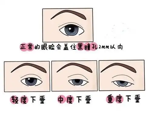 右眼上眼睑下垂之前做过一次手术但效果不好眼睛还是一大一小影响美观