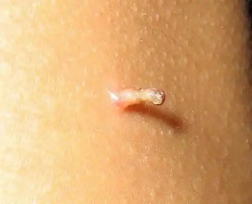 胳肢窝长肉疙瘩图片4