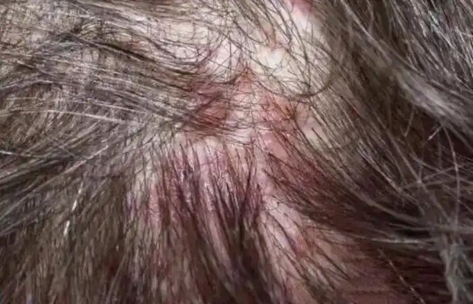 头皮,保持清洁,它就会发痒出油,引起脂溢性皮炎,一开始会长一些小疙瘩