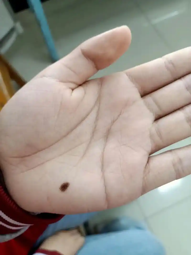 手上突然长的痣一定要尽早切除,孩子这个痣是偶然间发现的,当时 - 抖