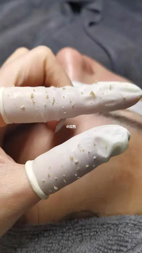 专业针清闭口黑头粉刺