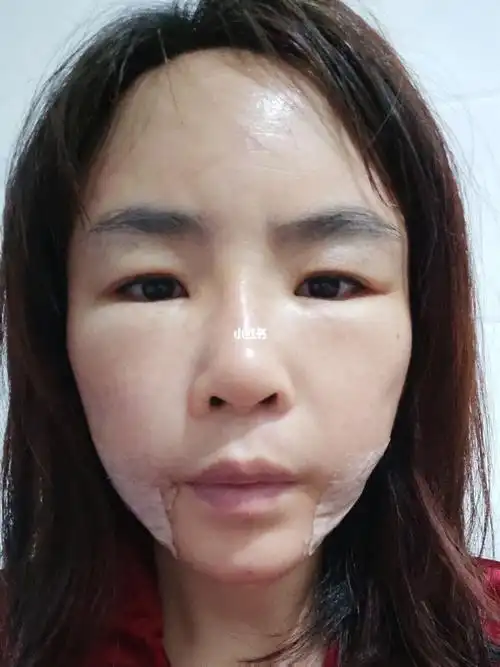 全脸脂肪填充第四天已经肿的眼睛都睁不开了