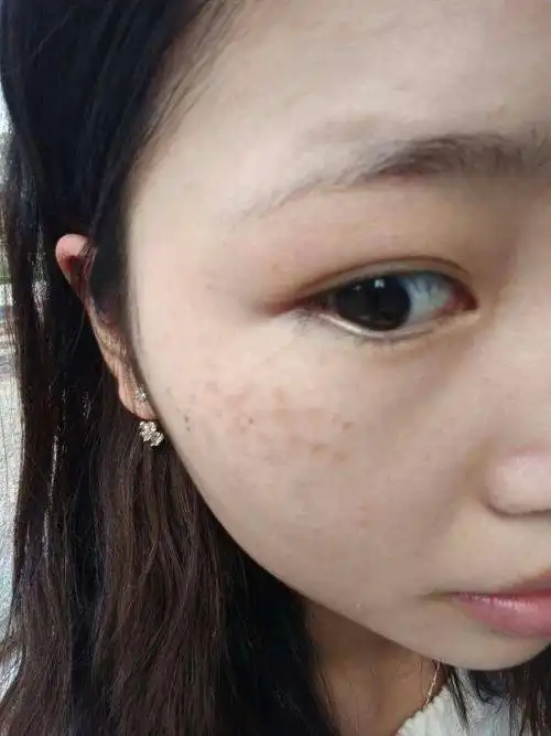 眼部长斑怎么办