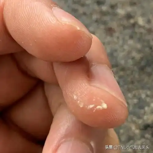 龟头上起白色脂肪粒