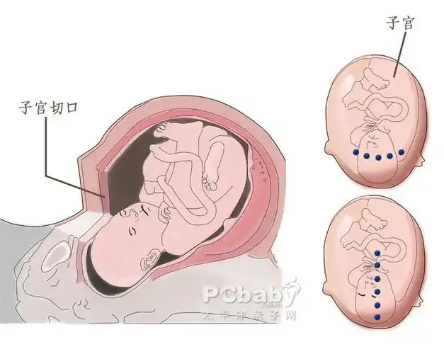剖腹产的最佳时间及产后注意事项