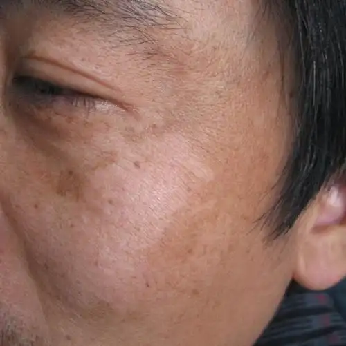 如何预防老年斑