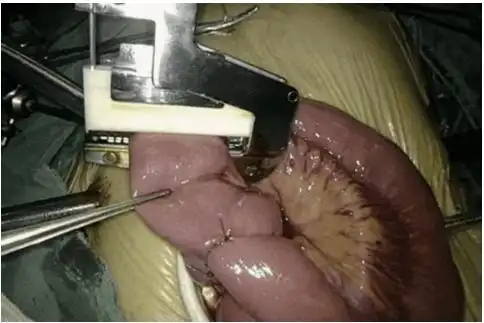 图12 国产60mm吻合器闭合肠管图13 国产60mm吻合器闭合肠管但不予以