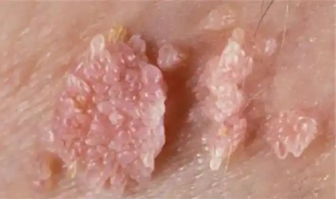 这些皮损增生可以是发生在生殖器的任何部位,包括男性尿道口,龟头