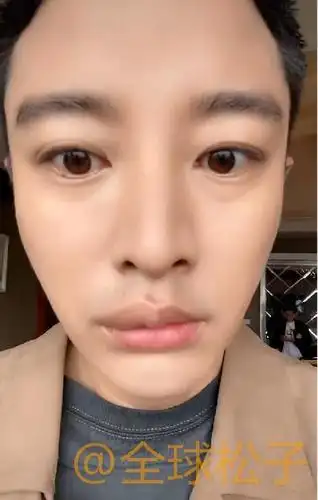 贾乃亮嘴唇被毒蚊子叮咬变"香肠",自我调侃称特别"性感"