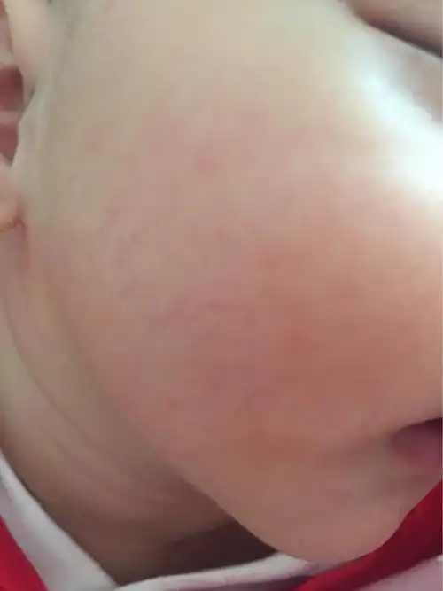 脸上的小血丝_百度宝宝知道