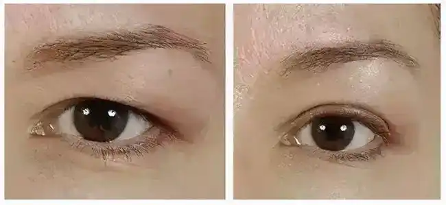 eye美颜究苑丨上了年纪眼皮松弛下垂影响美观怎么办