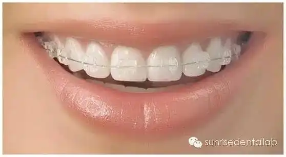 口腔矫正器的种类