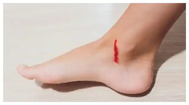 血糖高不高,低头看看"脚"!脚上出现"4怪像",及时检查血糖