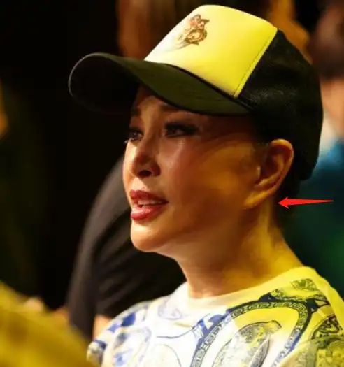 耳垂变形,满脸是坑,从刘晓庆到伊能静,明星拉皮后遗症太恐怖