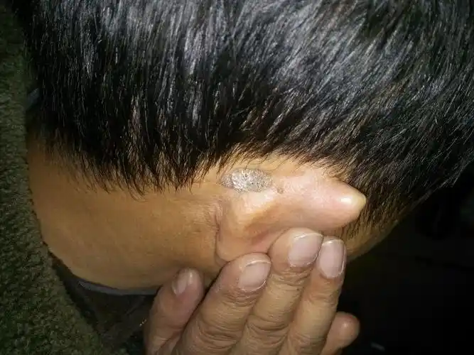 48岁 男 耳朵边上 长了一个肉疙瘩. 有时候有点痒.