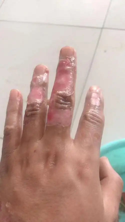 手烫伤了这感染了没