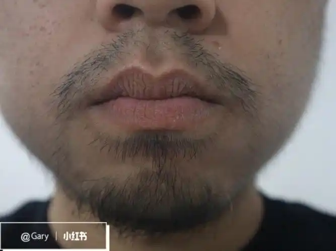 男士长胡子神器minoxidil5week8