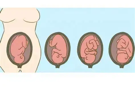 枕横位是什么意思