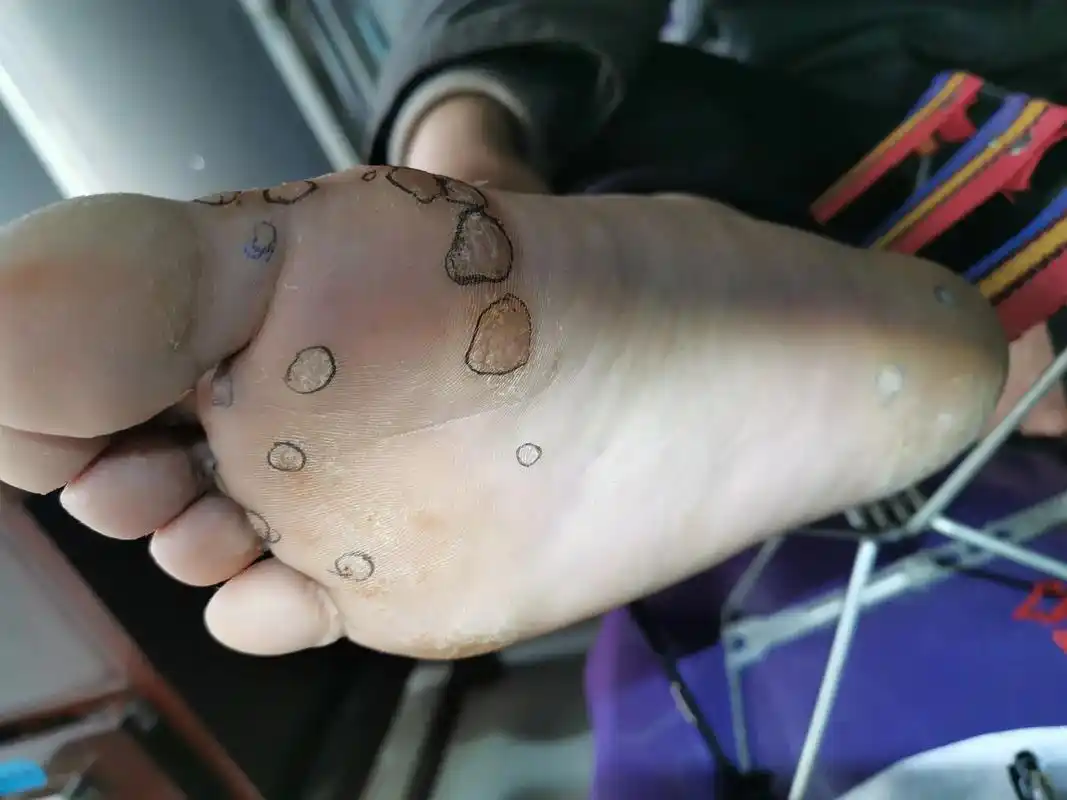 俗称瘊子,刺瘊,是一种常见的病毒感染性皮肤病,由人类 - 抖音