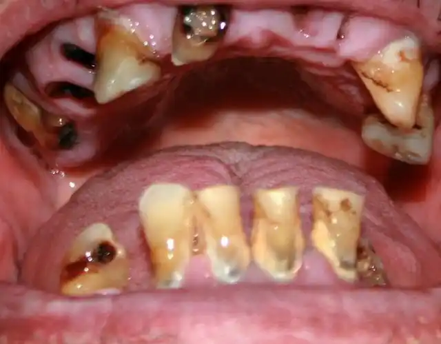 19岁游戏主播牙齿全烂光,只因一个坏习惯,很多人一打游戏也这样_口腔