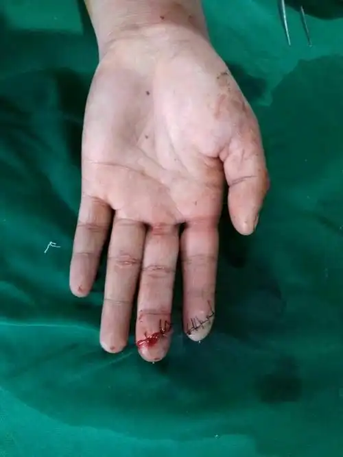 剁排骨不慎砍掉2根手指之--- -断指再植篇( 高精尖)
