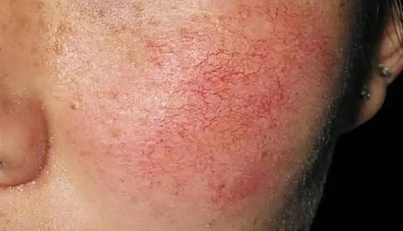 脸上的红血丝怎么消除?脸上为什么会有红血丝?