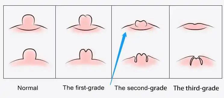 孩子乳头向内凹陷或呈一条裂缝样是什么问题?需要担心吗?