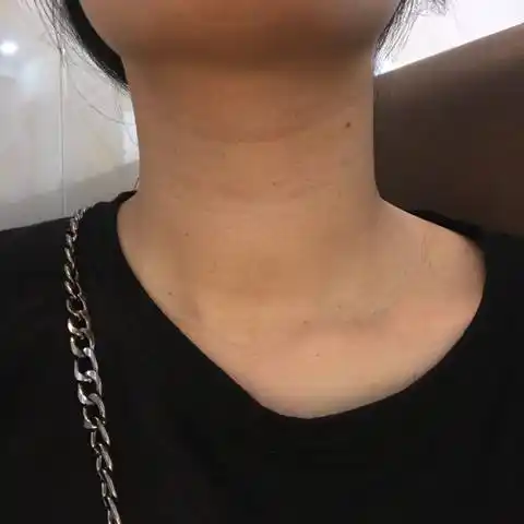 有没有怀孕期颈长长丝状疣的孕妈_宝宝树