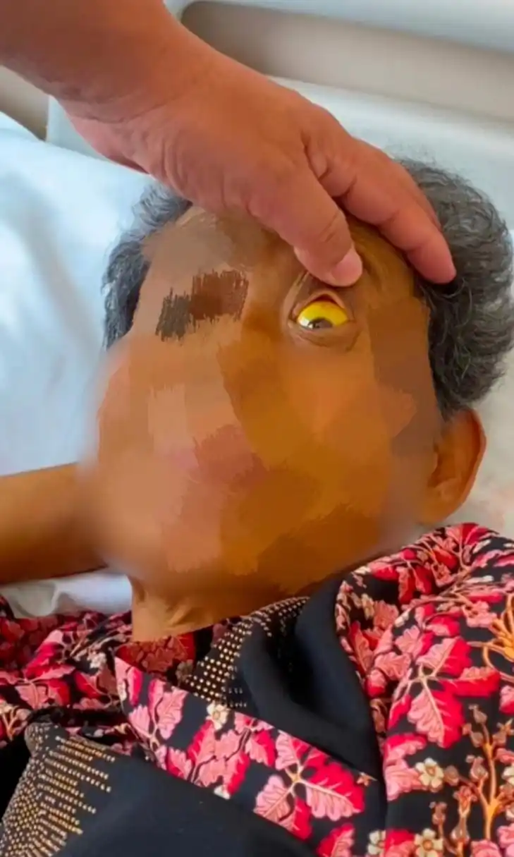 又是一位重症患者,肝硬化腹水,还严重黄疸!