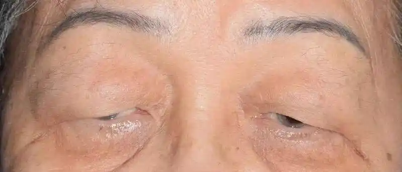 眼睛眯成一条线这不是小问题可能是重症肌无力