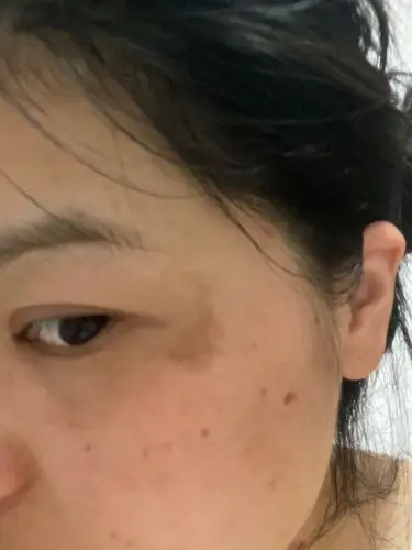 有没有姐妹能告诉我我这眼睛周围长的这些黑斑是什么斑_圈子-新氧美容