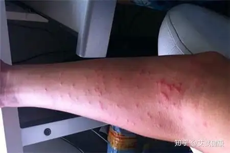 这才是艾滋病的症状,不要乱猜