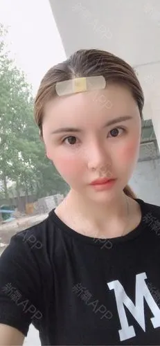 自体脂肪填充全脸