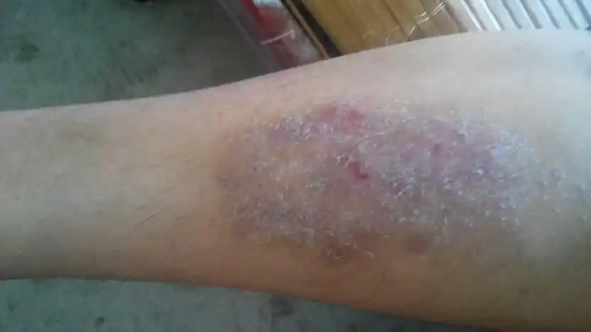 这不是死皮,这是一种局部皮肤坏死.