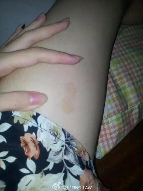 洗完澡后发现我的大腿内侧.