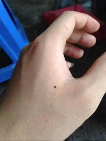 手背上有痣,代表此人有技艺在身,为人心思缜密,是计算精确之人