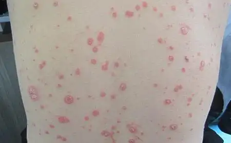 早期的点滴状牛皮肤癣的临床特别是什么样_潍坊东方银屑病研究院_潍坊