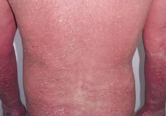 红皮病型牛皮肤癣的种类图片症状