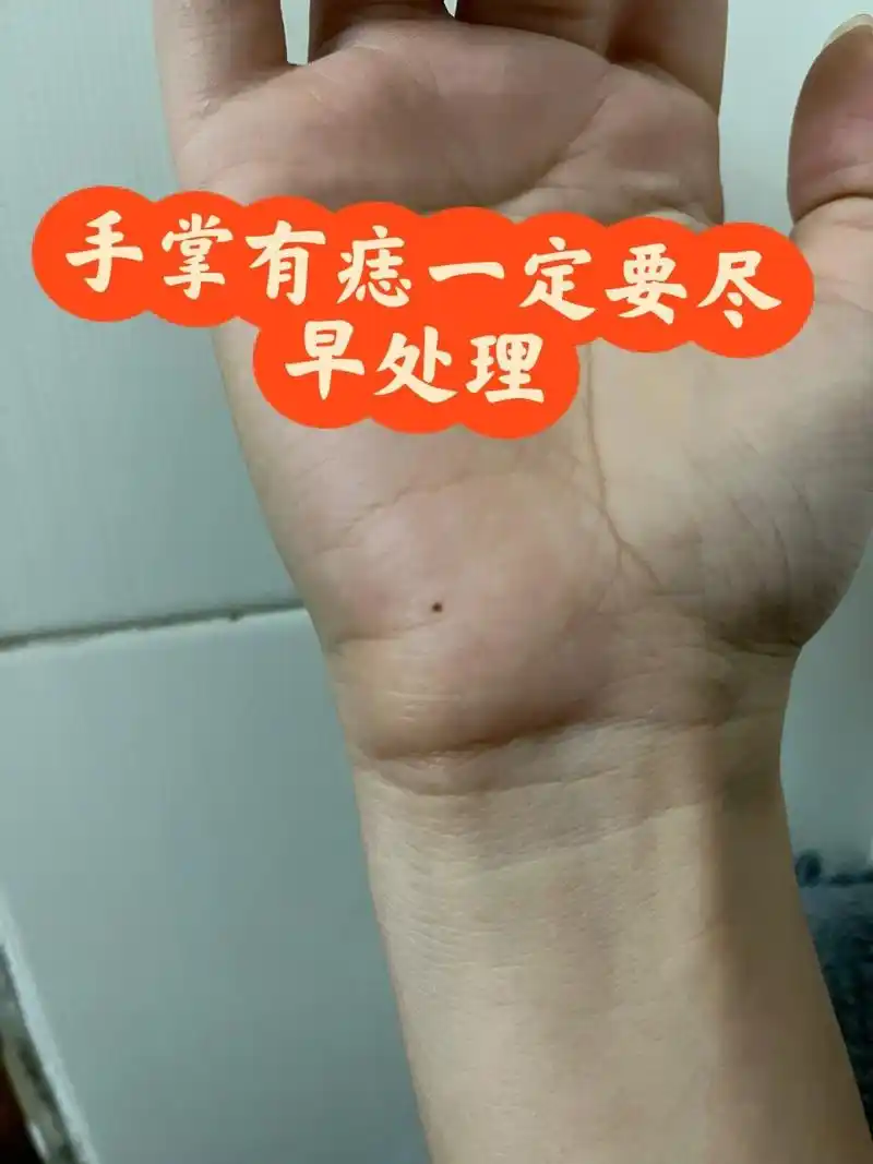 手掌长痣 今天去医院,医生说还好早来,现在还小可以激光,大一点就要